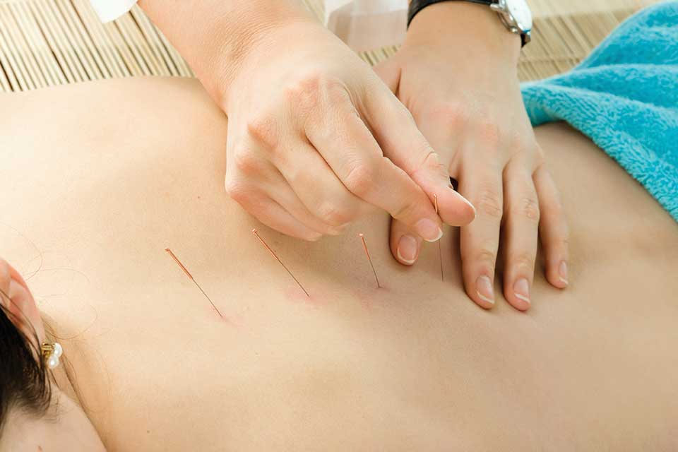 Acupuncturist placing needles along the spine of a patient's back